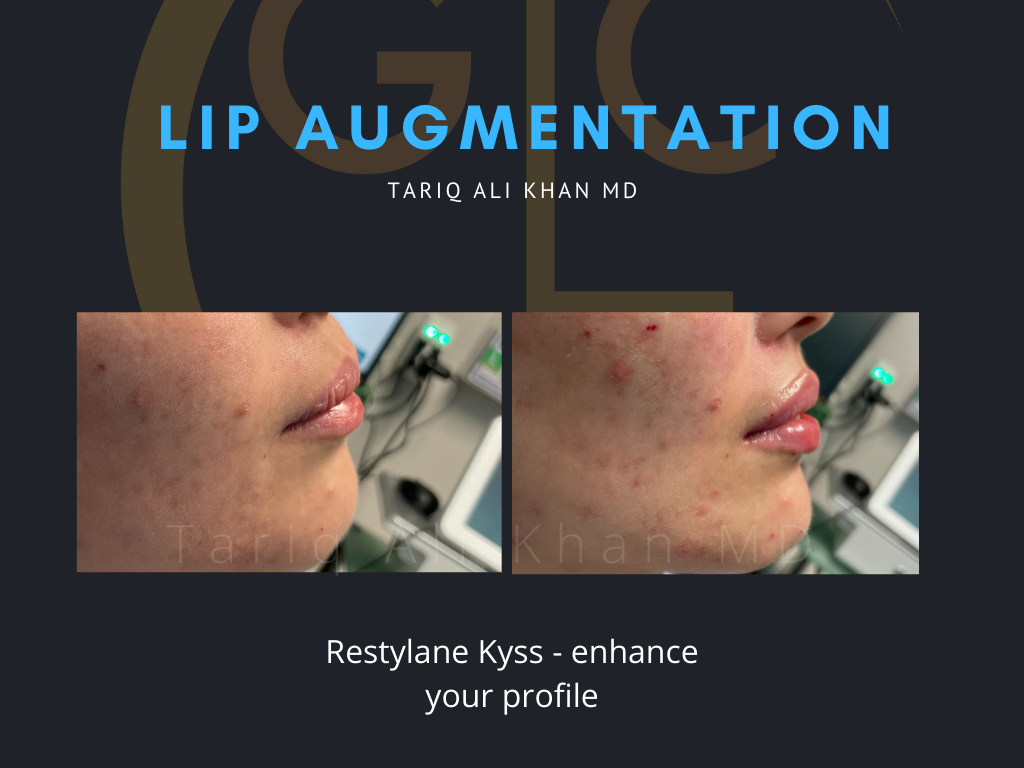 Gentle Care Laser Tustin Before and After picture - Lip Augmentation